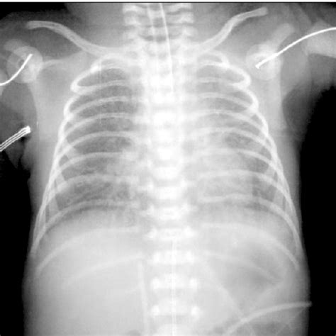 Chest Radiograph On Admission Showing Diffuse Pulmonary Infiltration Of