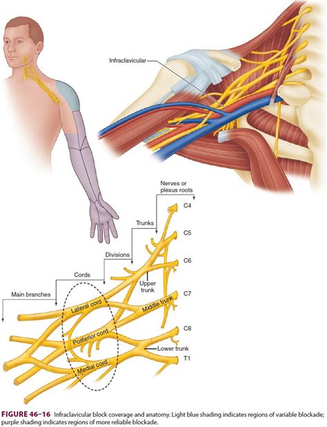 Upper Extremity Peripheral Nerve Blocks Infraclavicular Block