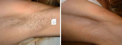 The pigment in the hair follicle absorbs two challenges are red and gray hair; Underarm Laser Hair Removal in Seattle « Island ...