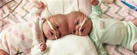 Conjoined Twins Have Survived One Of The Worlds Rarest Surgeries Sciencealert