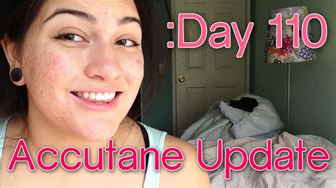 Day 110 Accutane Severe Acne Update Giveaway Closed July 4 2013 1159