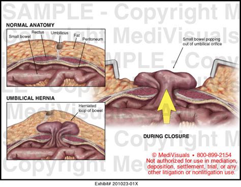 Umbilical Hernia Medical Illustration Medivisuals