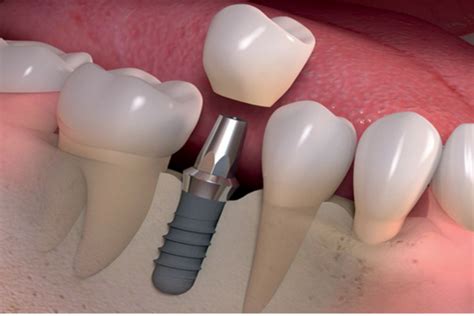 Los Tipos De Implantes Dentales Y Materiales Usados Clinica Dental