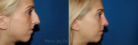 Rhinoplasty Photos Chevy Chase Md Patient 9364