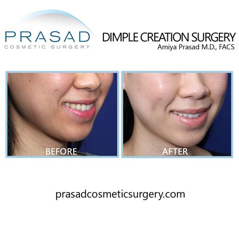 Dimple Surgery Dimple Creation Learn More New York