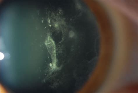 Vitreous Amyloidosis Slit Lamp Photo Retina Image Bank