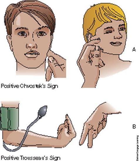 Signs Of Hypocalcemia And Hypoparathyroidism A Chvostek S Sign B