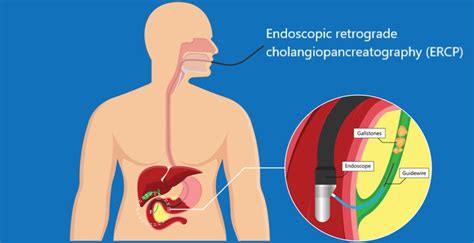 Ercp Endoscopic Retrograde Cholangio Pancreatography Gleneagles