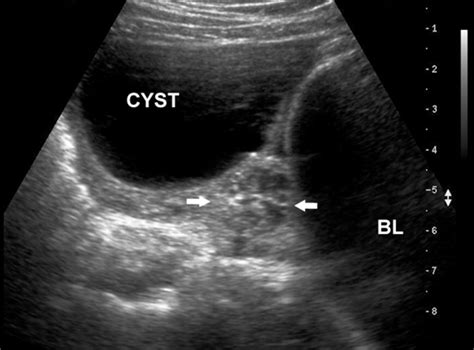 Ovarian Torsion Ultrasound Findings