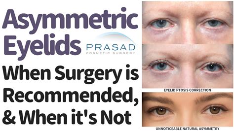 Asymmetrical Eyes When Surgery Is Recommended Dr Prasad