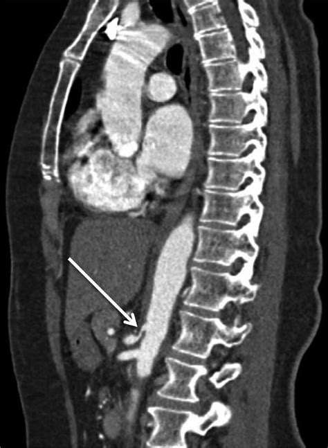 Sagittal Ct Of The Aorta Showing Thickening Of The Wall Of The Aorta