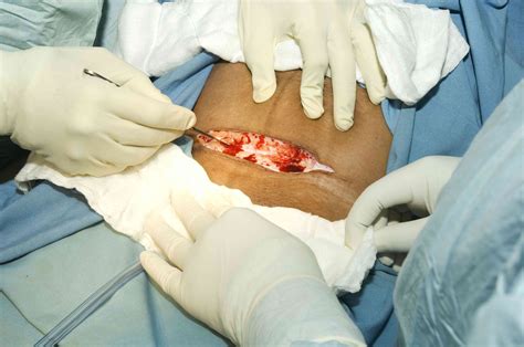 Cesarean sections are classified according to the technique and incision used in the procedure. Cesarean Section Procedure, Step by Step