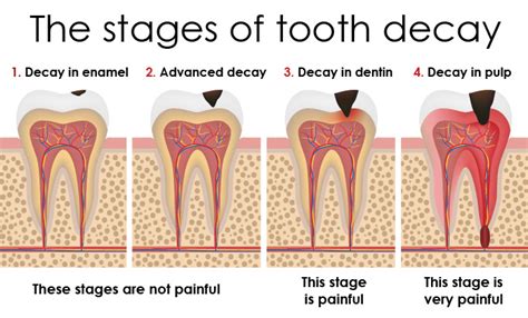 What Causes Tooth Decay And How To Treat It Helpful Tips