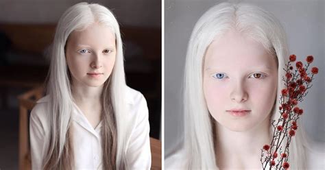 Photographer Captured The Unique Beauty Of A Girl With Albinism And