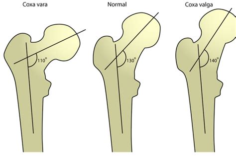 Coxa Vara Causes And Treatment Bone And Spine