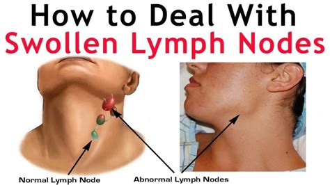 Swollen Lymph Nodes In Neck One Side Children Or Adults