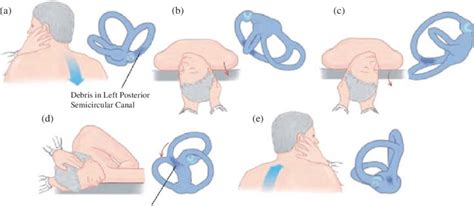 Modified Epley Maneuver For Treating Left Sided Bppv Reproduced From