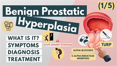 What Is Benign Prostatic Hyperplasia Overview For Med Babes Urology YouTube