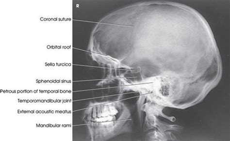 Rte 221 Radiographic Positioning And Procedures Skull Image Evaluation