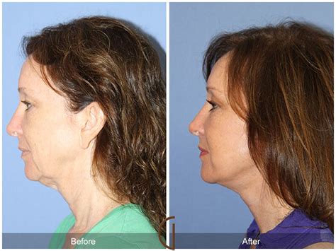 Neck Lift Before And After Photos Patient 122 Dr Kevin Sadati