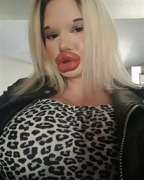 Woman Who Says She Has Worlds Biggest Lips Wants Them Bigger Despite Risks Chicagodrawbridges