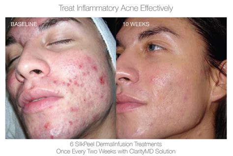 Silkpeel Before After 1 Dean Dermatology And Skin Therapy
