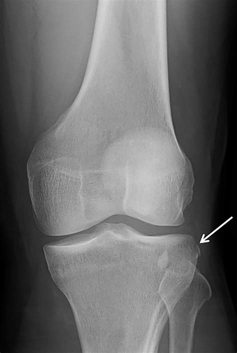 Anteroposterior Radiograph Demonstrating An Avulsion Fracture At The