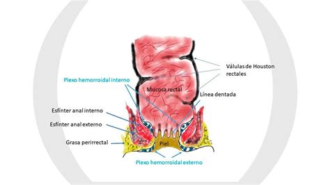 Colgajos Hemorroidales Fisura Anal Y Hemorroides Clínica Dr Linares