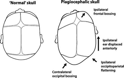 Features Of Positional Plagiocephaly Compared With A Normal Skull The
