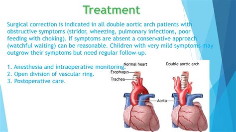 Hypoplastic Left Heart Syndrome Online Presentation
