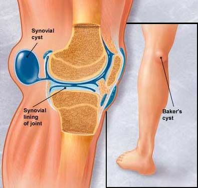 Maybe you would like to learn more about one of these? Baker's Cyst - Lump Behind the Knee by Dr Kevin Yip ...