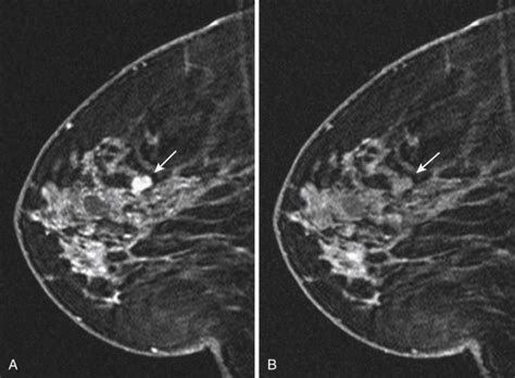 Benign Findings In Breast MRI Radiology Key