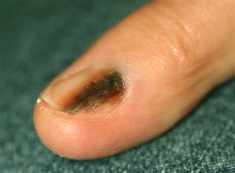 Nail Bed Melanoma Pictures Photos