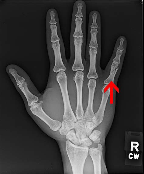 Hand And Wrist Fractures