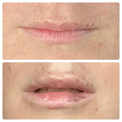 Before And 3 Days Post Lip Filler 1ml Juvederm Ultra Plus 1st Time