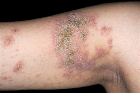 Prevalence Of Atopic Dermatitis 73 In Us Adults The Clinical Advisor