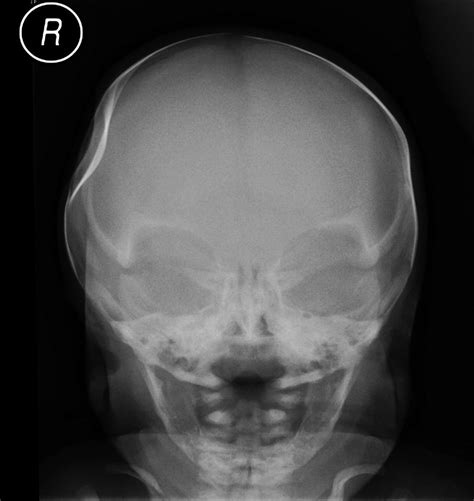 Congenital Skull Indentation A Case Report And Review Of The