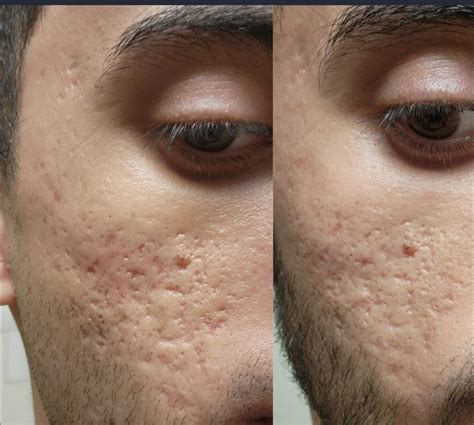 Rf Secret Microneedling Results After 4 Treatments 26 Days After Last