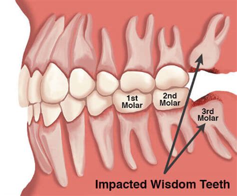 .that said, we understand typos are real! At What Age Do Wisdom Teeth Come In? | Dental Dorks