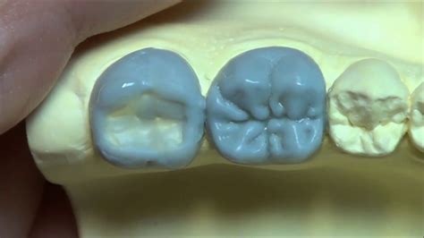 Live Wax Up Lower 2nd Molar Contour Youtube