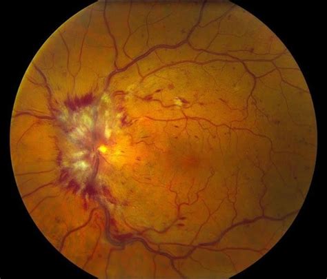 Central Retinal Vein Occlusion 1 Retina Image Bank