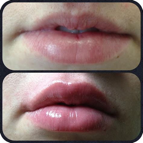 This Client Had A Signficantly Smaller Upper Lip And Our Registered