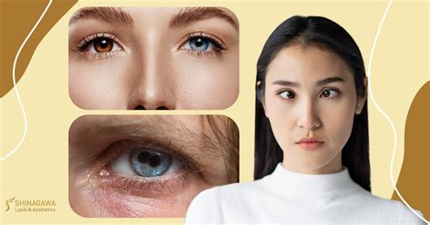 Knowing Rare And Bizarre Eye Conditions Shinagawa Blog