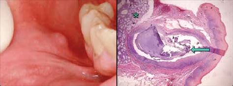 Left Clinical View Of A Superficial And Mobile Lesion Affecting The