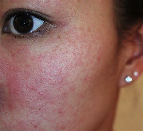 Allergic Reaction To Makeup Rash Mugeek Vidalondon
