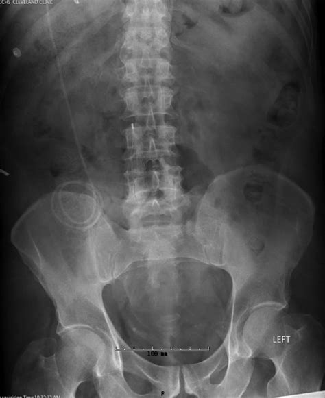 Post Operative Abdominal X Ray After Distal Catheter Trimming