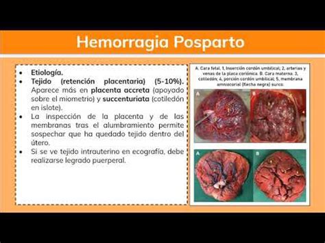 Hemorragia Posparto Ginecología YouTube