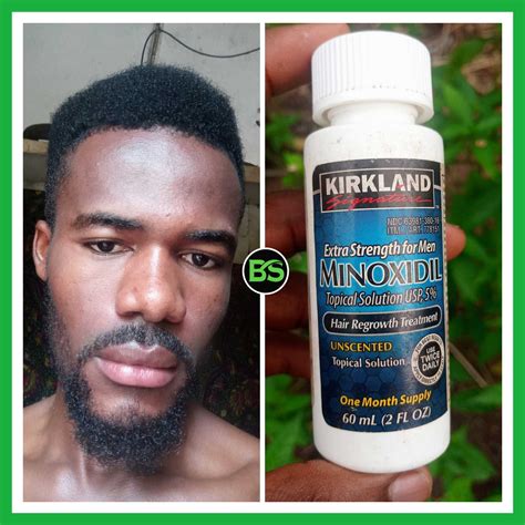 Share 135 Can Minoxidil Cause Hair Loss Vn