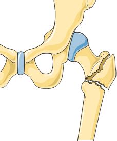 Osteoporosi, osteopenia, diagnosi e cura dell'osteoporosi