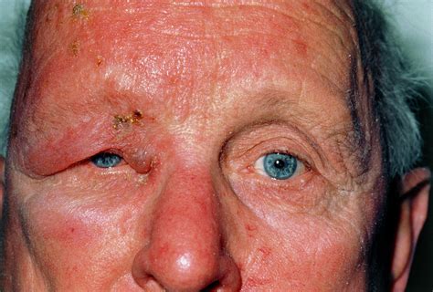 Man Affected By Shingles Herpes Zoster Photograph By Dr P Marazzi